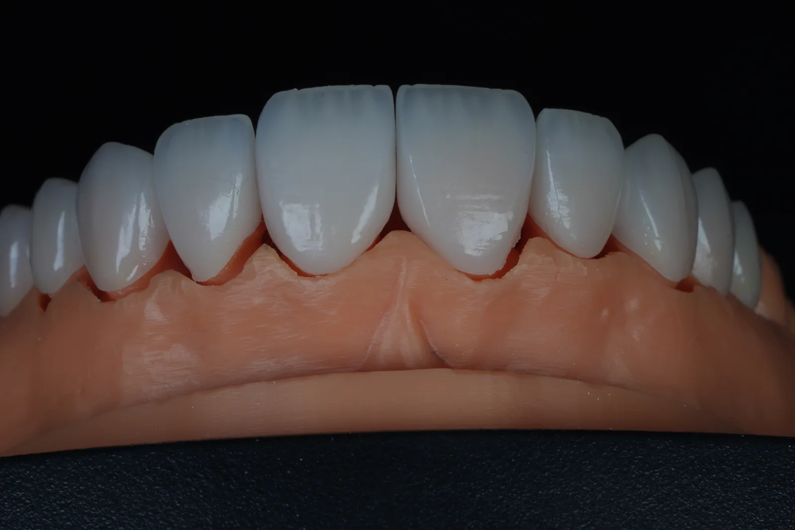 Emax Veneer — Case 2 photo 2