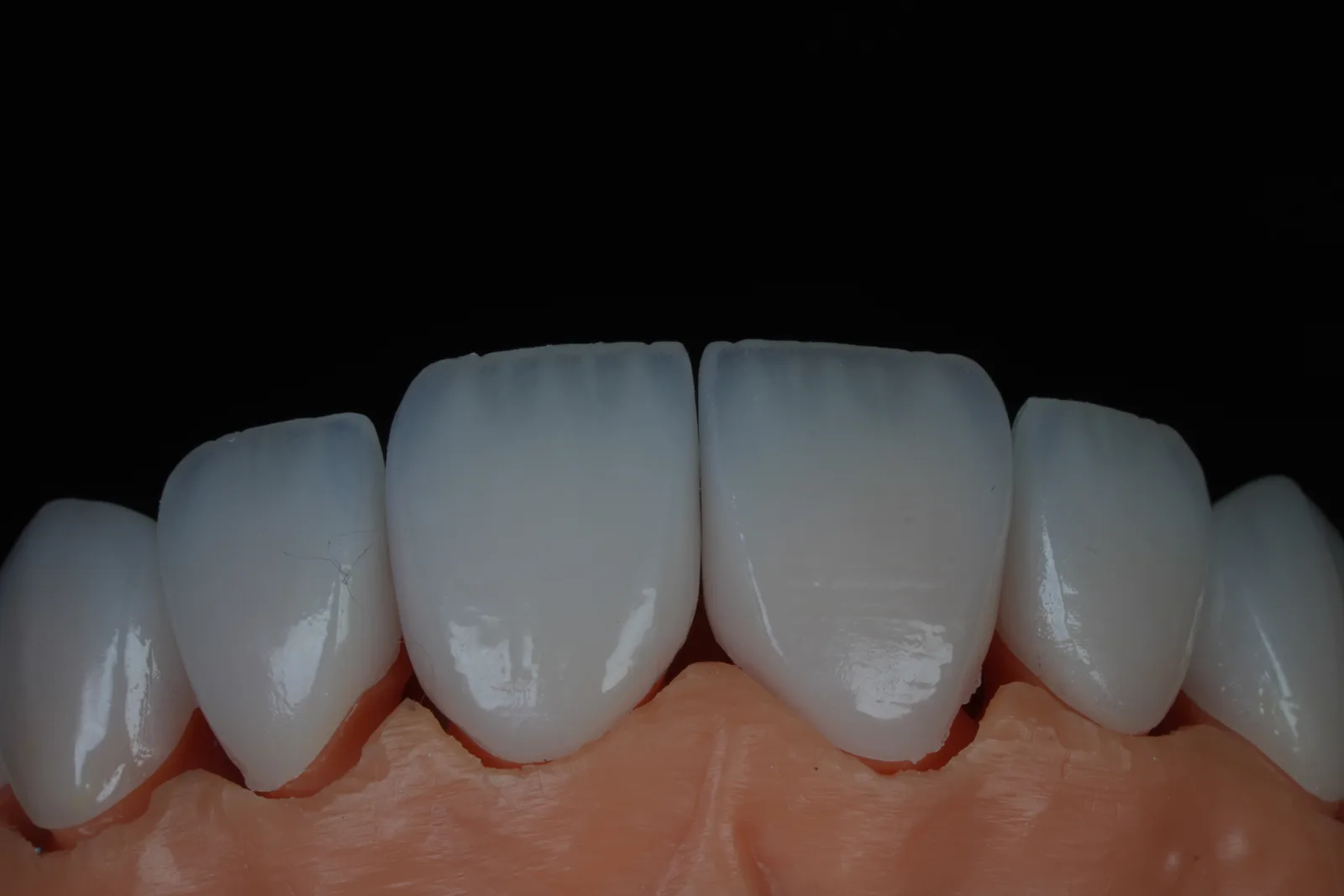Emax Veneer — Case 2 photo 3