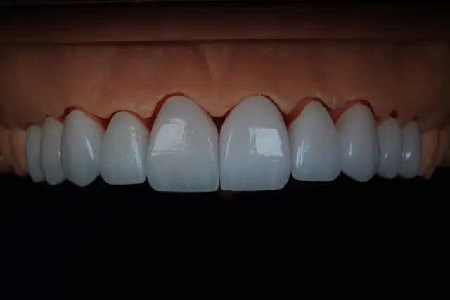 Emax Veneer — Case 2