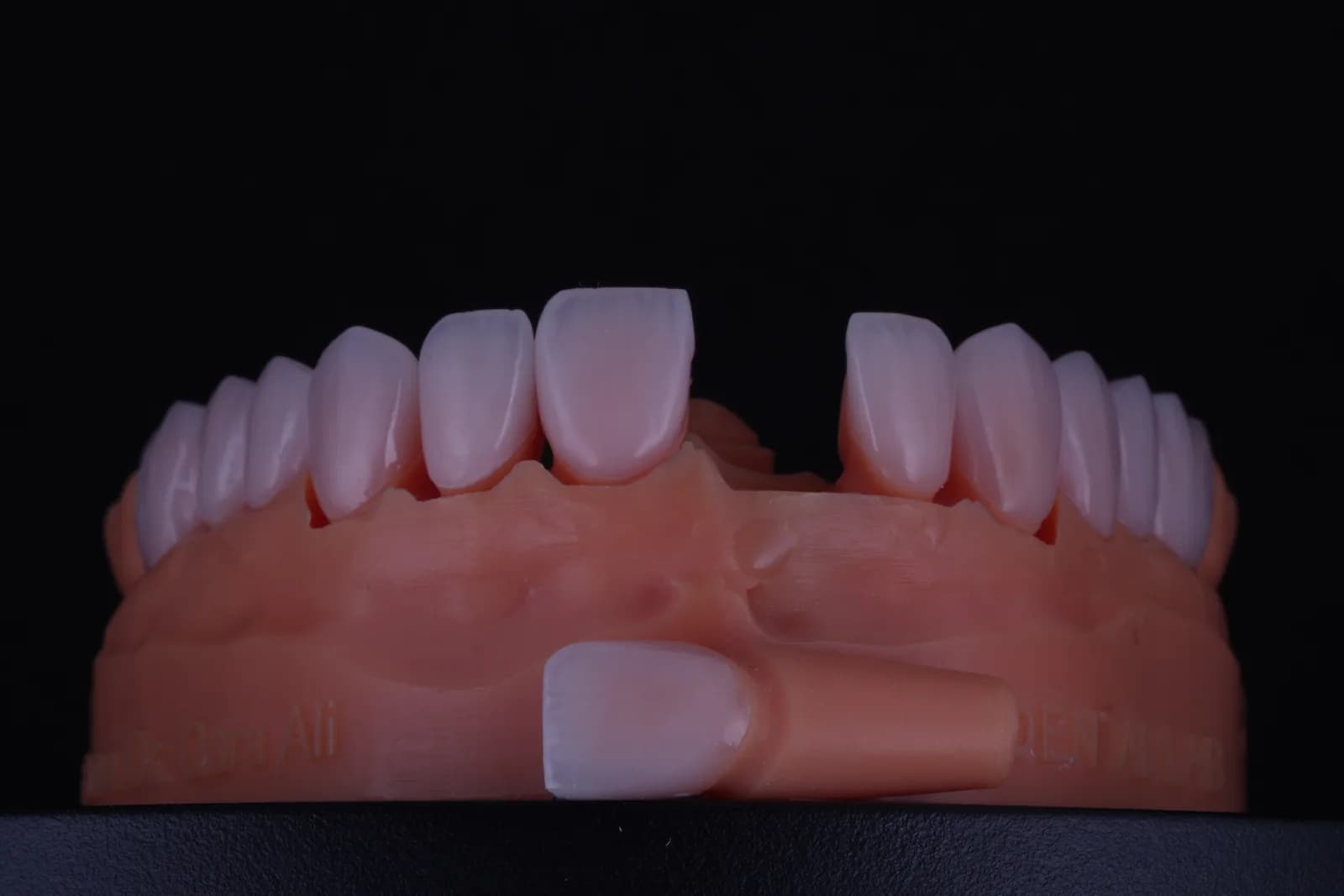 Feldspathic Veneer — Case 1 photo 2