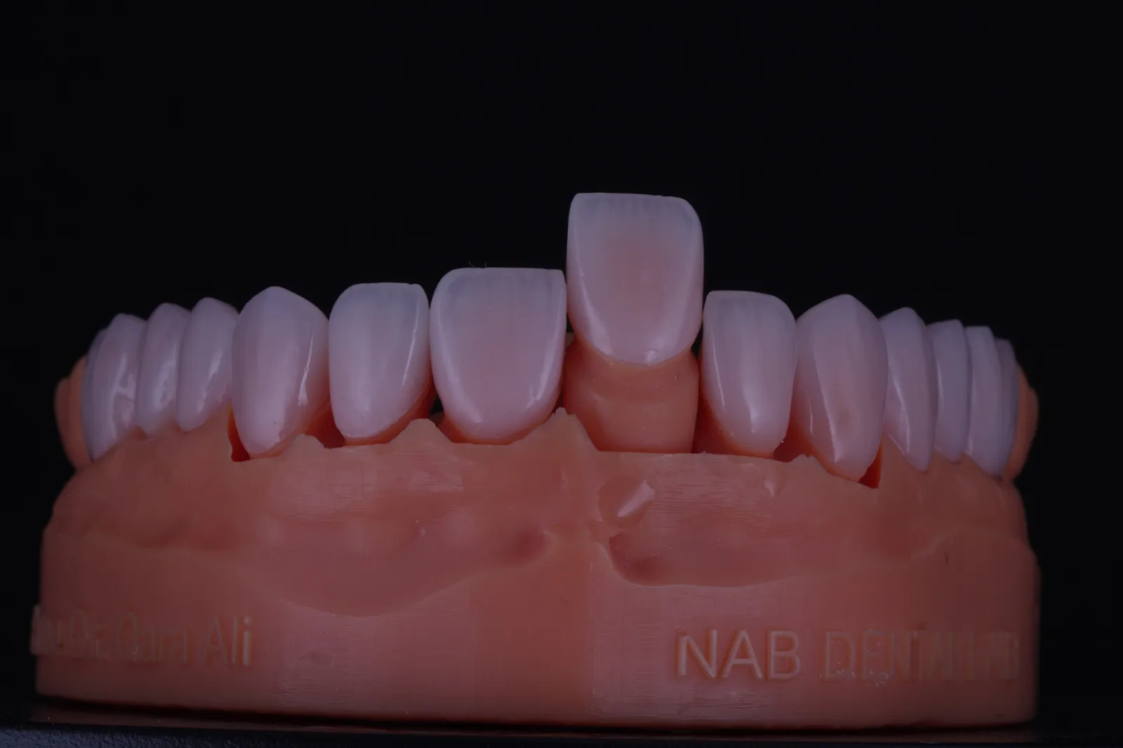 Feldspathic Veneer — Case 1 photo 3