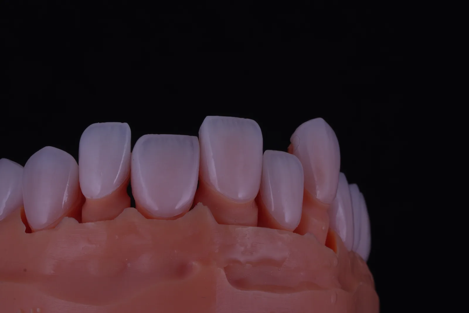 Feldspathic Veneer — Case 1 photo 4