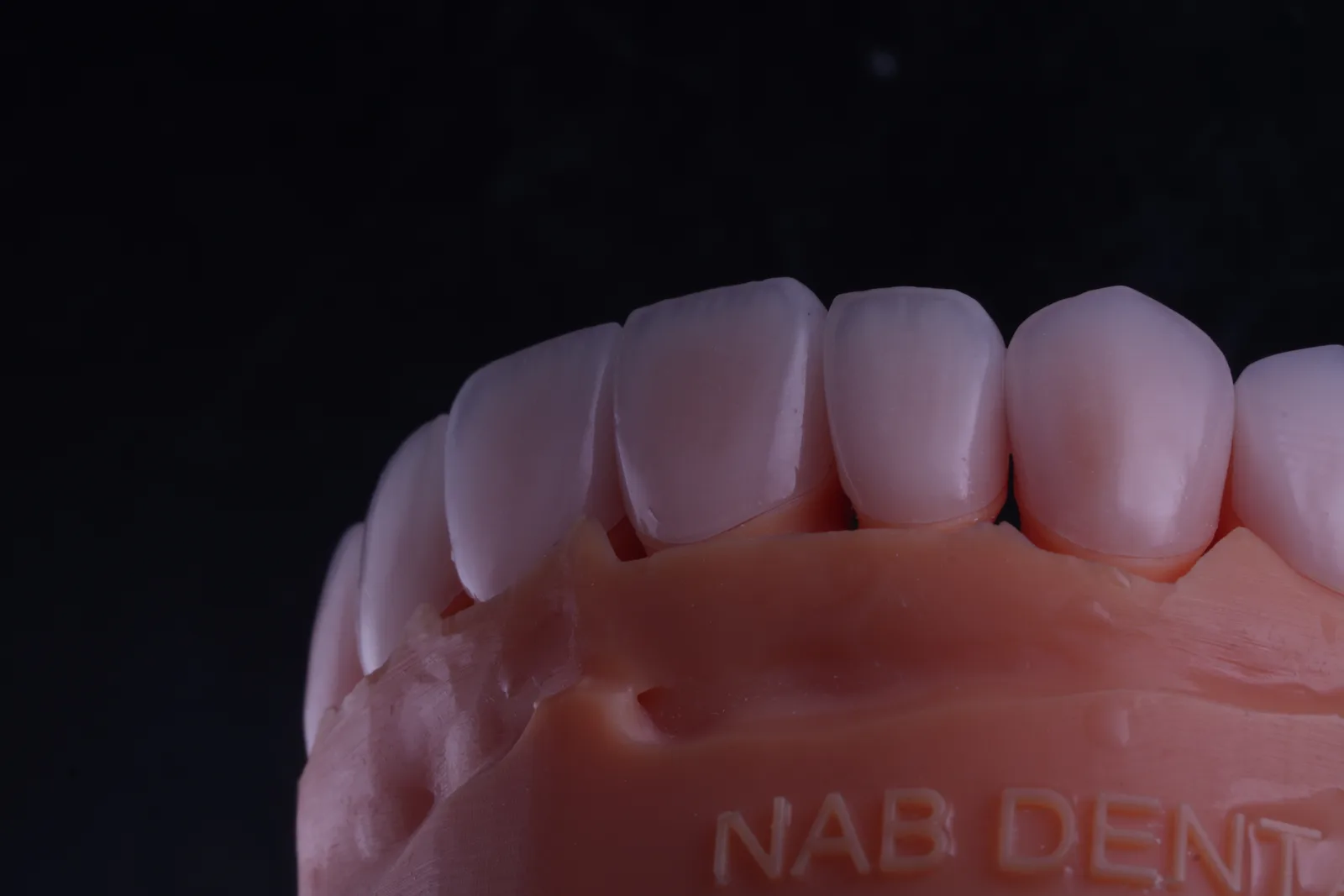 Feldspathic Veneer — Case 1 photo 5