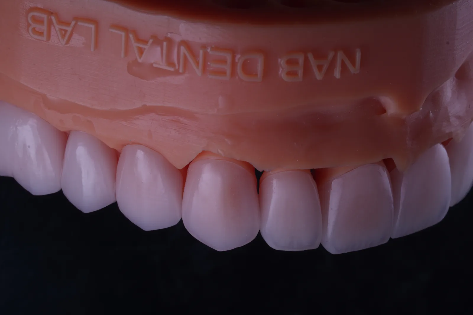 Feldspathic Veneer — Case 1 photo 6