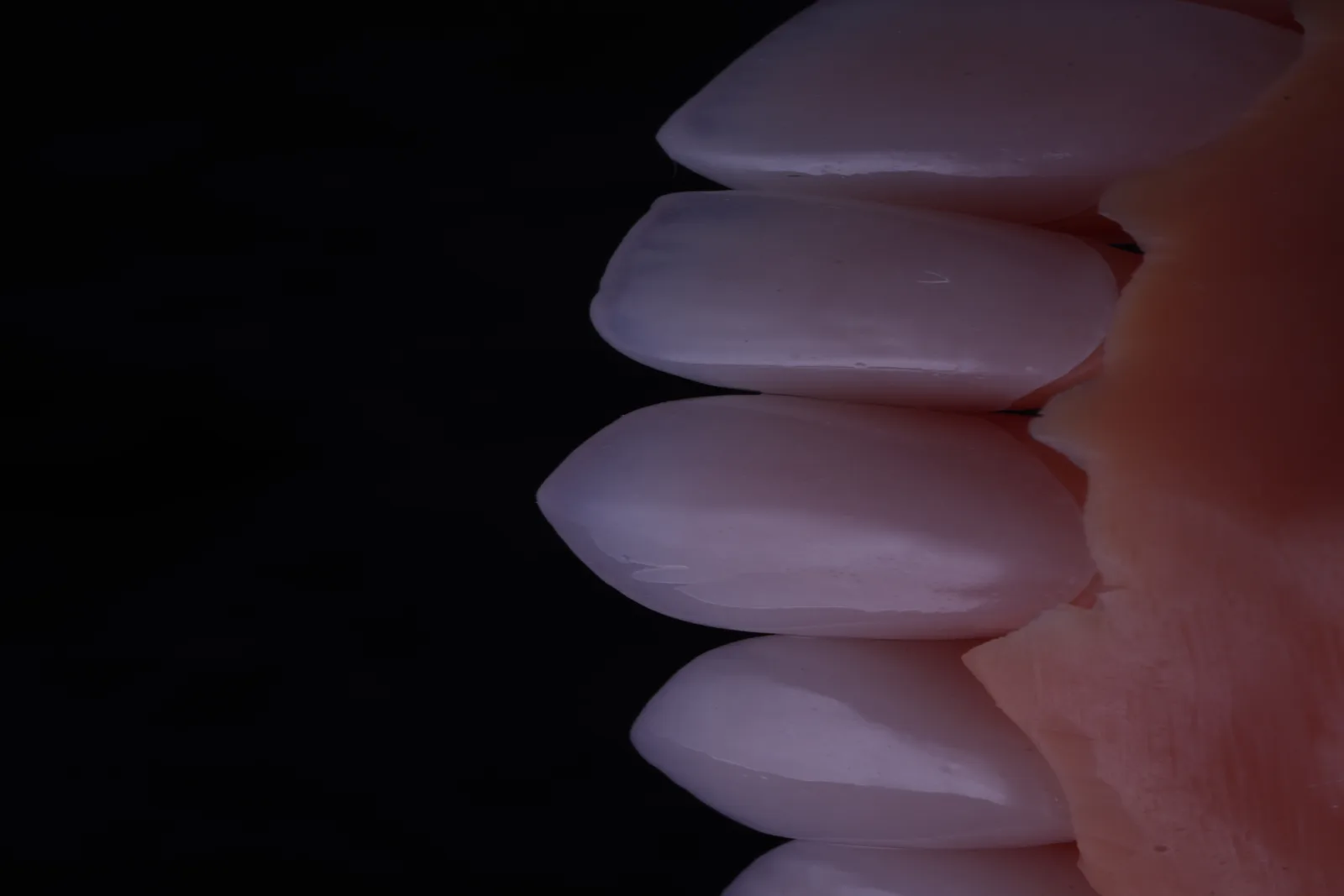 Feldspathic Veneer — Case 1 photo 7