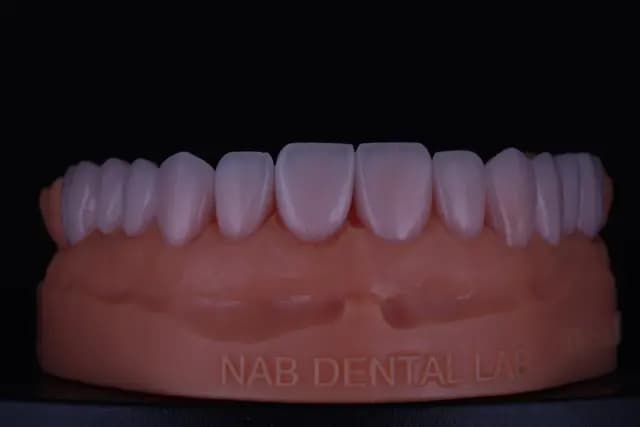 Feldspathic Veneer — Case 1