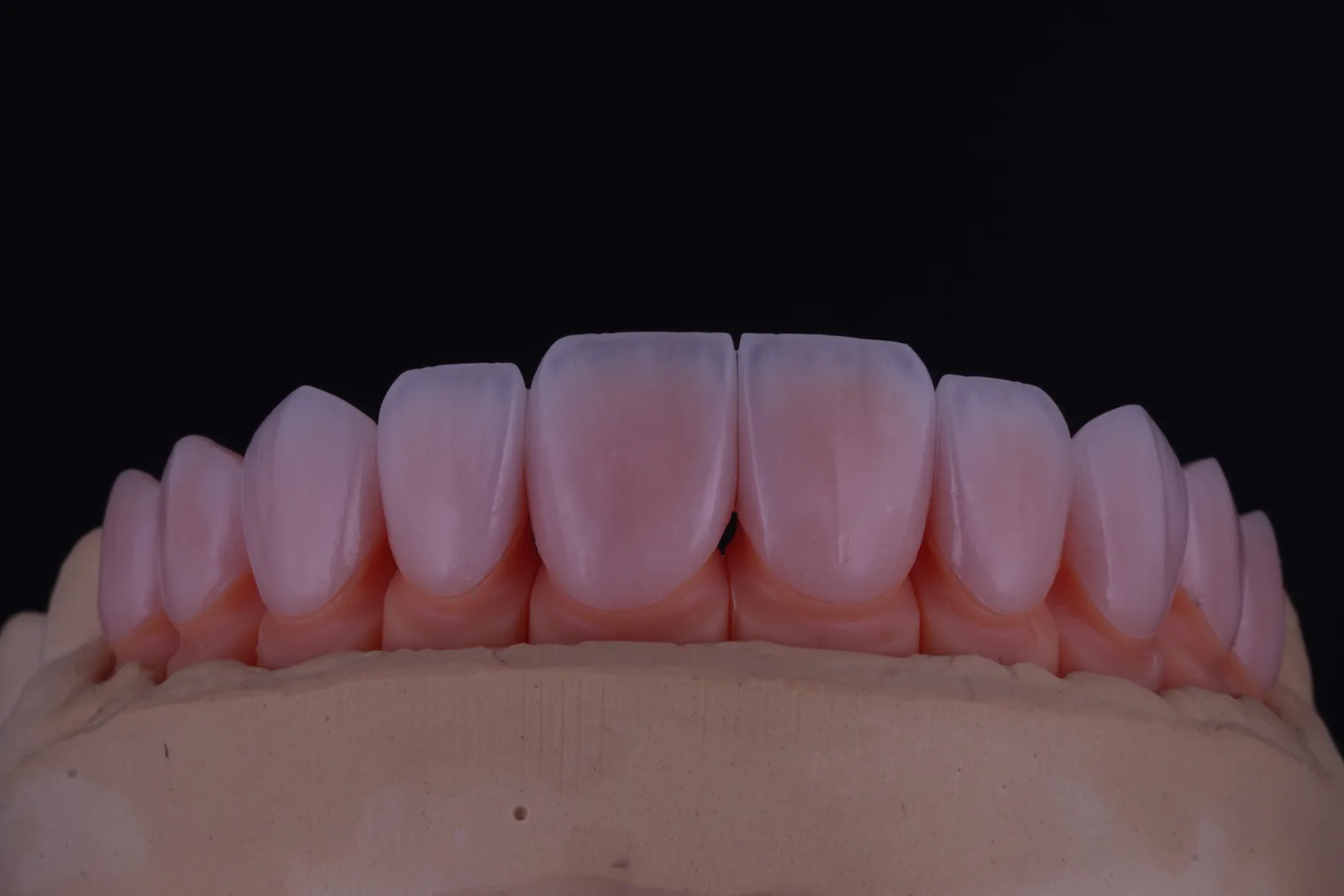 Feldspathic Veneer — Case 2 photo 2