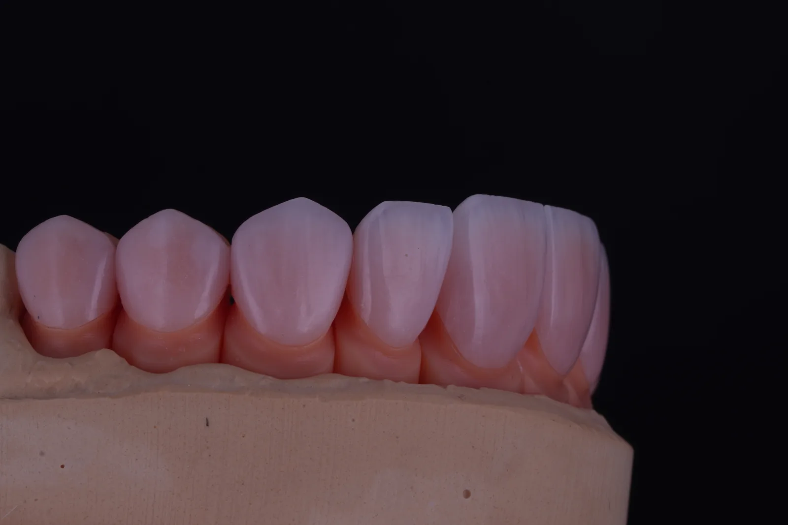Feldspathic Veneer — Case 2 photo 3