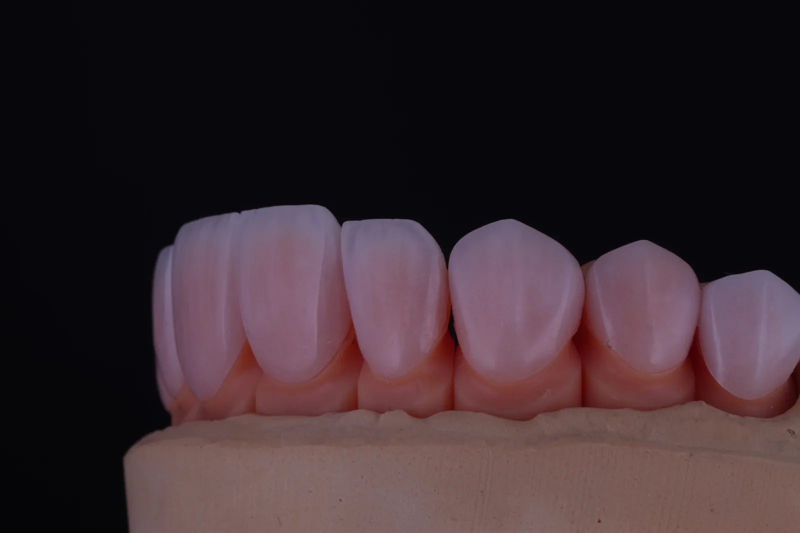 Feldspathic Veneer — Case 2 photo 4