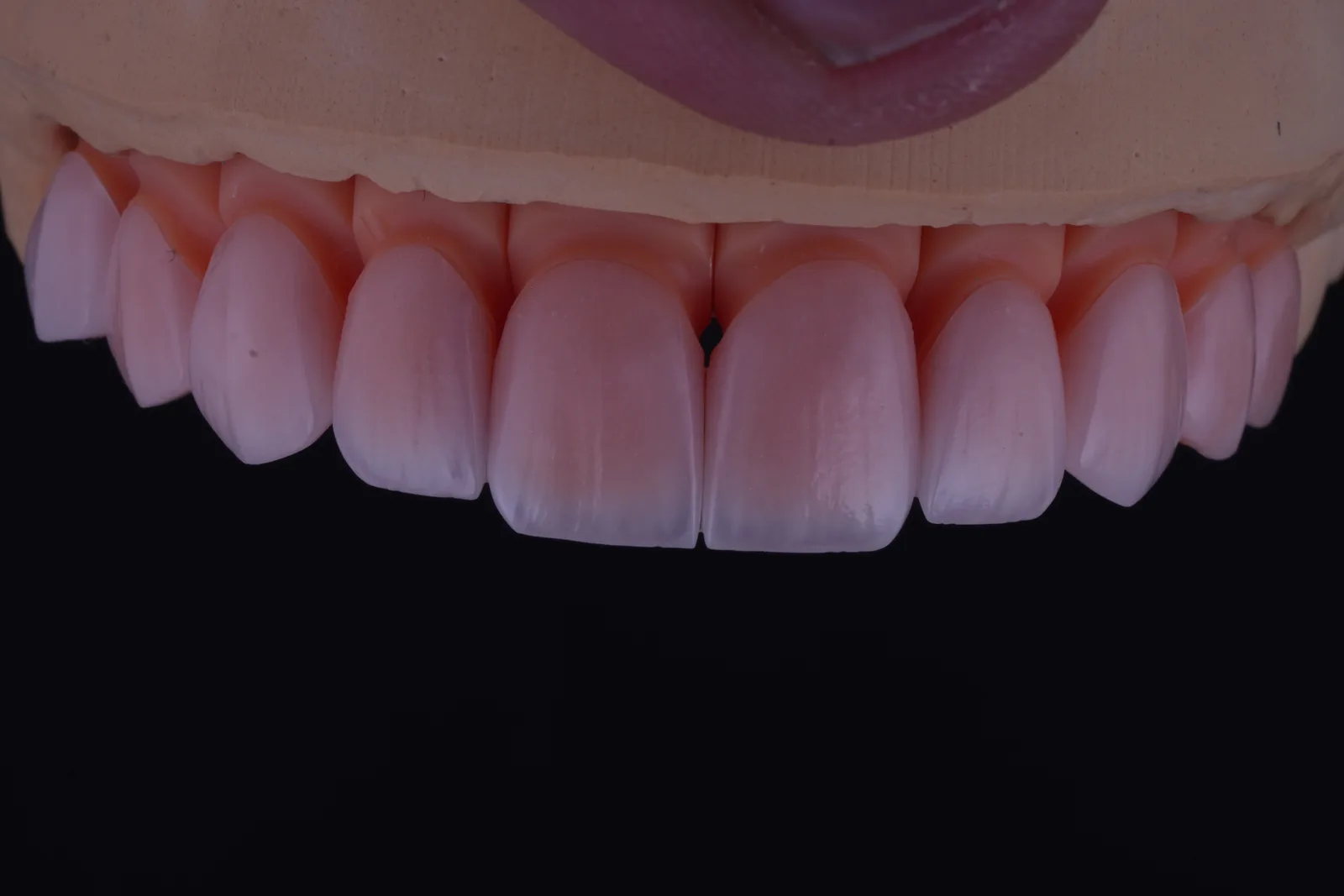 Feldspathic Veneer — Case 2 photo 1