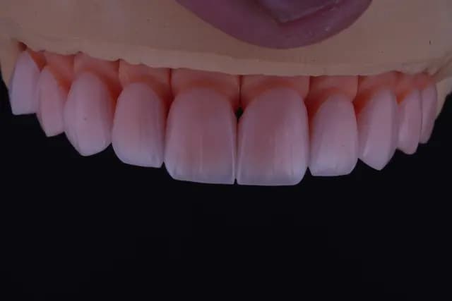 Feldspathic Veneer — Case 2
