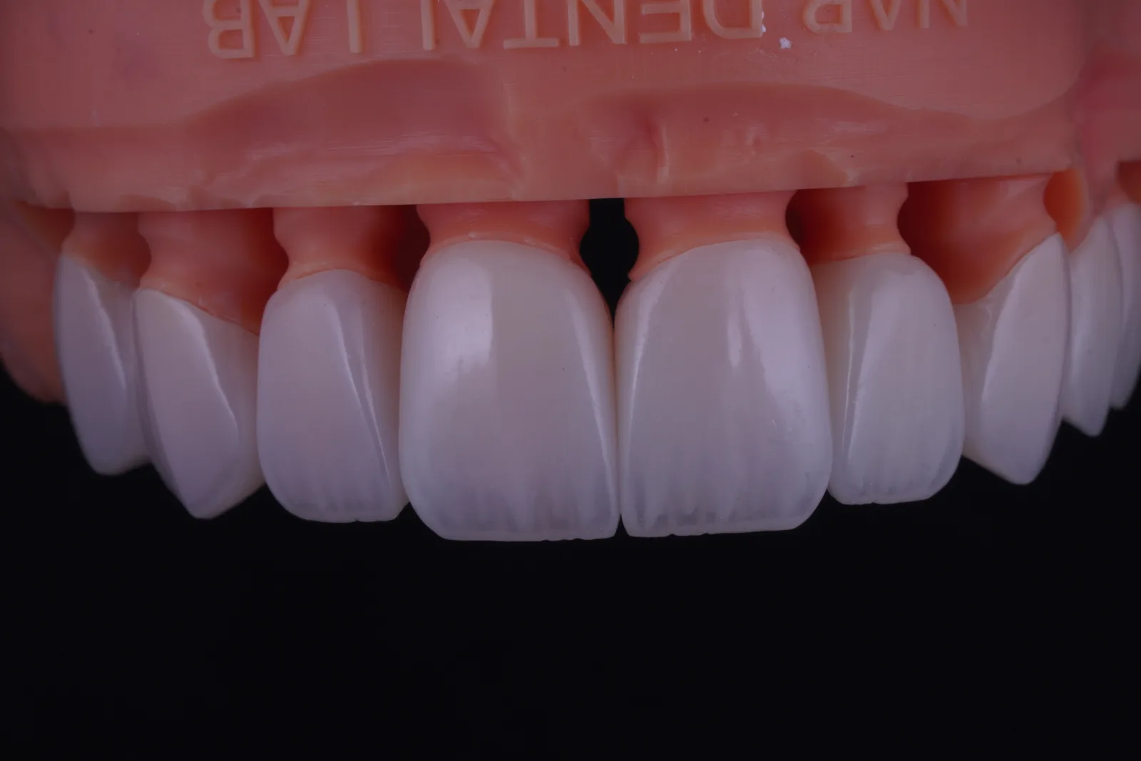 Modern Veneer — Case 1