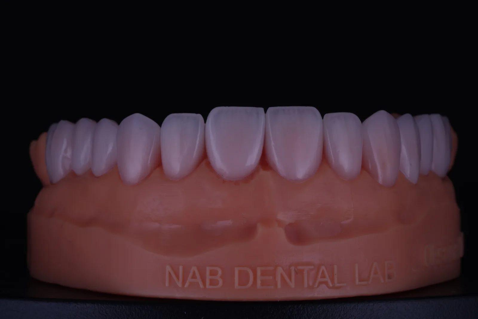 Feldspathic Veneer — Case 1